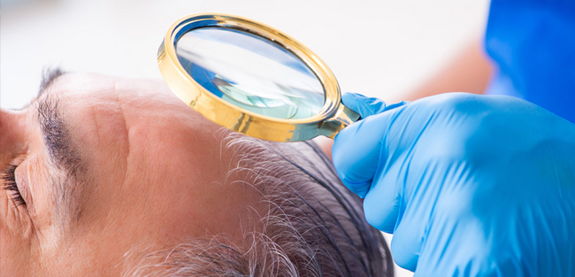 umsatzsteuerbefreiung-fuer-haarwurzeltransplantationen-bei-haarausfall